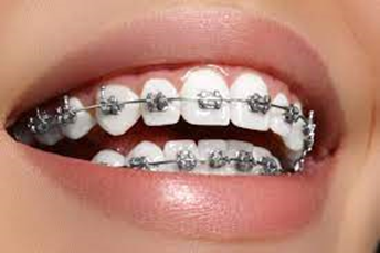 behel konvensional