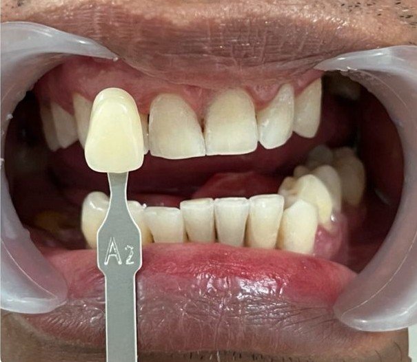 Kondisi gigi pasien sesudah perawatan bleaching di Klinik GDC