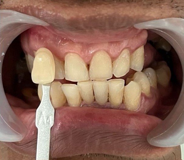 Kondisi gigi pasien sebelum perawatan bleaching di Klinik GDC