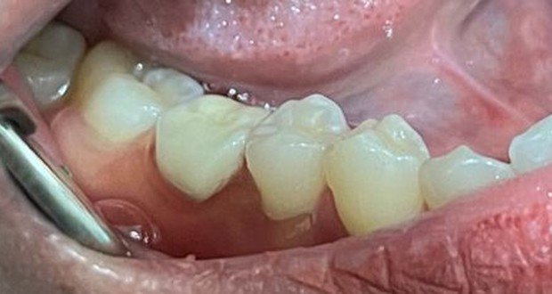 Kondisi gigi pasien sesudah pemasangan gigi palsu di Klinik GDC