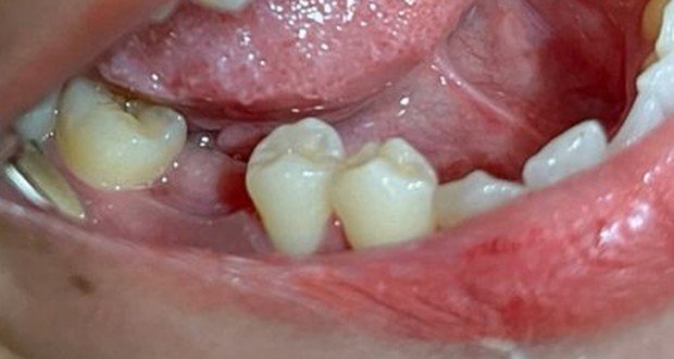 Kondisi gigi pasien sebelum pemasangan gigi palsu di Klinik GDC