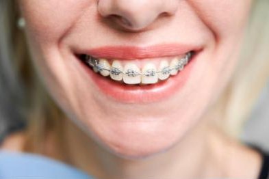 Behel keramik dengan bracket berwarna menyerupai gigi