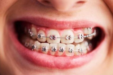Behel metal dengan bracket stainless steel terpasang pada gigi