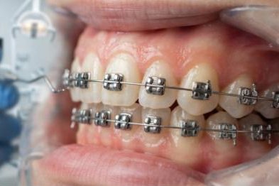 Behel self-ligating dengan sistem klip penahan kawat tanpa karet elastis