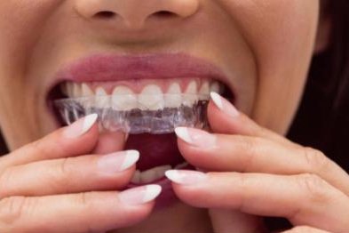 Clear aligner bening dipasang pada gigi
