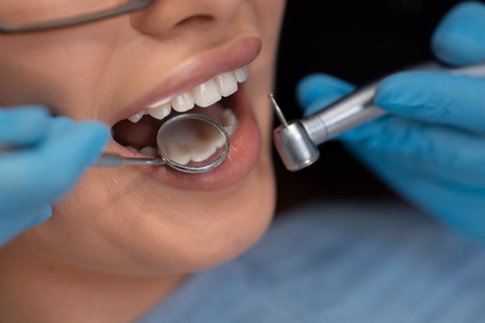 Scaling dan Bleaching Gigi: Perlu Dilakukan Berurutan atau Bisa Bersamaan?